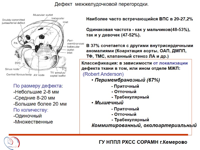 ГУ НППЛ РХСС СОРАМН г.Кемерово Дефект  межжелудочковой перегородки. Наиболее часто встречающийся ВПС в